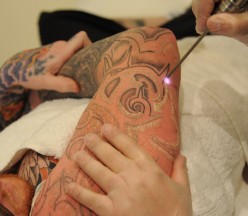 Laser Tattoo Removal course - 2 Day Workshop